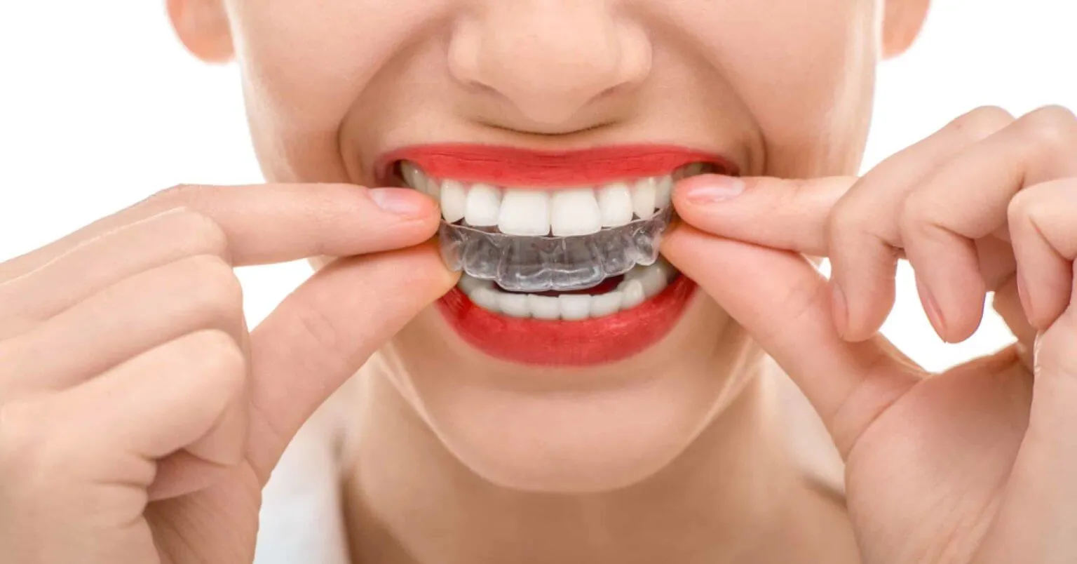 Close-up of a person fitting a clear aligner over their upper teeth