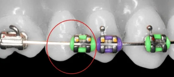 Illustration of braces on teeth with a red circle highlighting one bracket