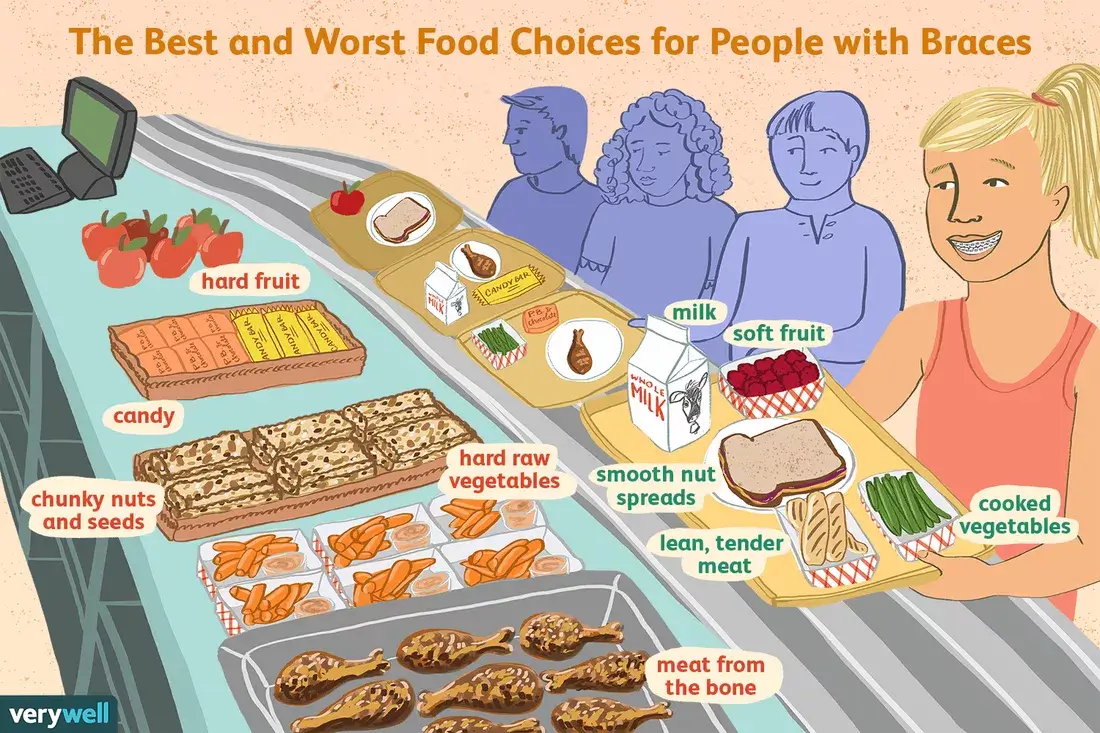 Illustrated chart of the best and worst food choices for people with braces, from soft fruit and cooked vegetables through to hard nuts, candy and meat on the bone