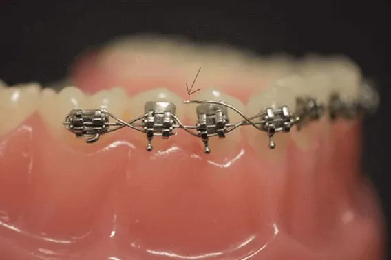 Close-up of braces and archwire fitted along the lower teeth